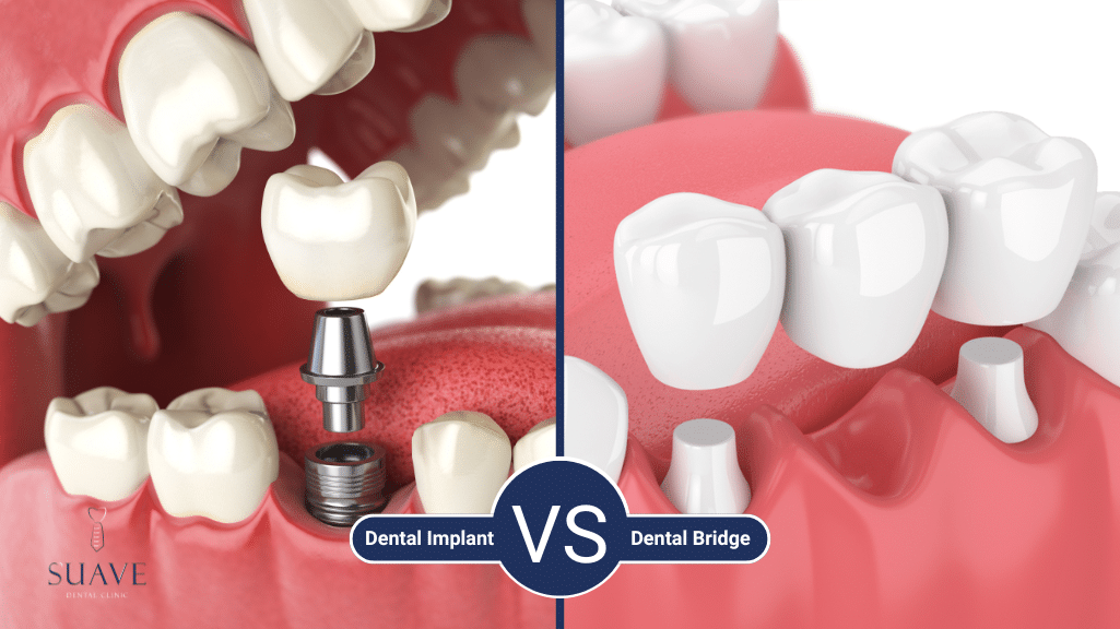 dental bridge vs implant https://suaveclinic.co..